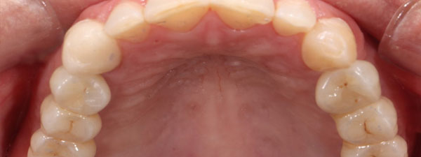 Dental Impants After 9