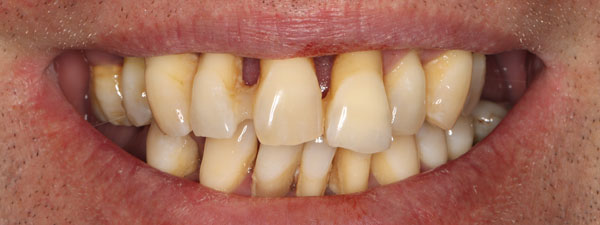 Dental Impants Before 2