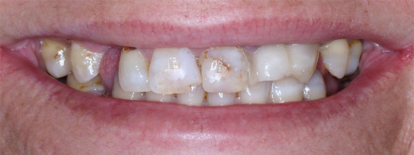 Dental Impants Before 4