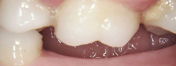 Dental-Impants-Before-7