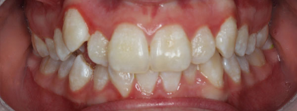 Kid's-Dentistry-Before-&-After-1
