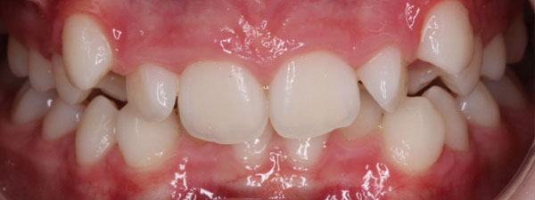 Kid's-Dentistry-Before-&-After-5