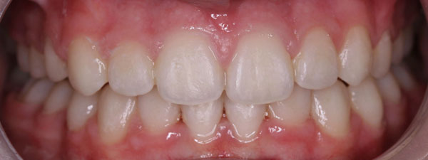 Kid's-Dentistry-Before-&-After-6