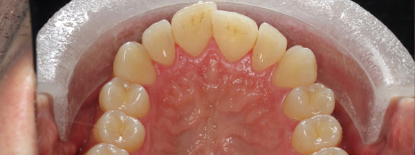 Occlusal-Before