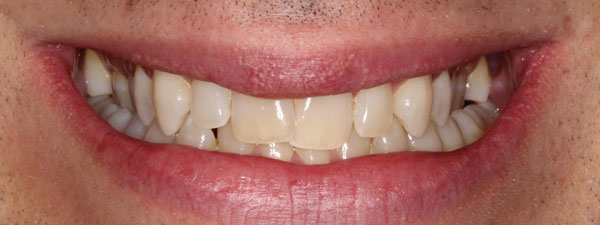 Orthodontics-&-Whitening-After