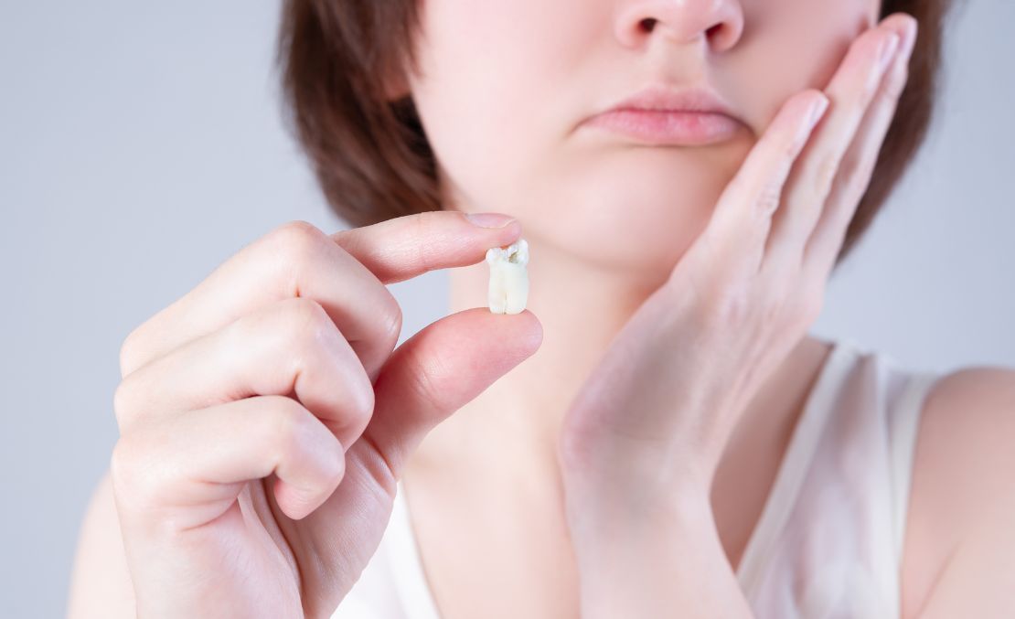 Wisdom Teeth Removal